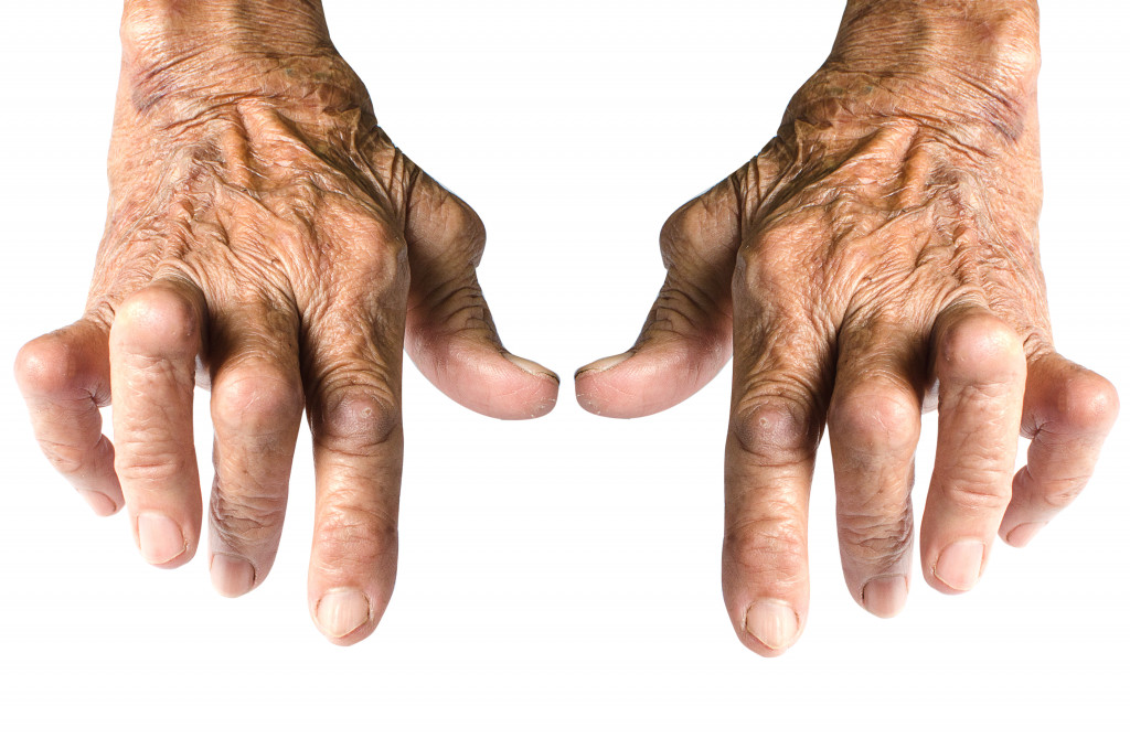 Arthritis on hand